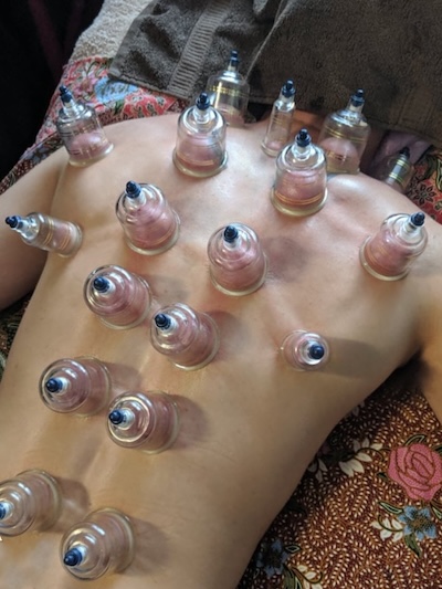 Thai Massage Cupping Treatment